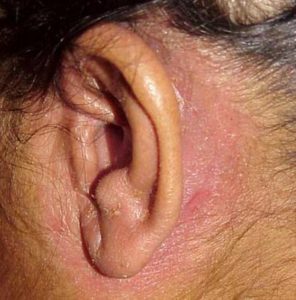 Seborrheic Dermatitis behind Ears