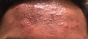 Small Bumps on Forehead Itchy