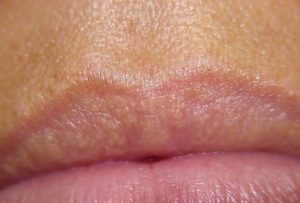 Lips on small bumps tiny How to