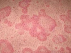 Fungal Rash On Penis 95