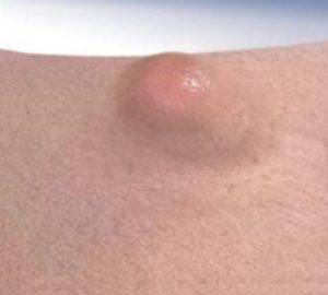 A Cyst on Inner Thigh