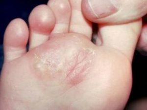 Bump on Bottom of Foot caused by Athlete's Foot