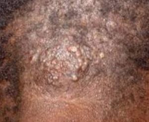 Bumps on Scalp causing Hair Loss