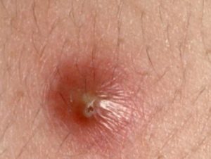 Cyst on Inner Thigh Male