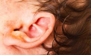 Ear Canal Eczema Symptoms include Itching