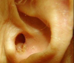 Ear Canal Infection may be the cause of Itching