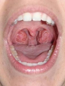 Holes in Tonsils Image