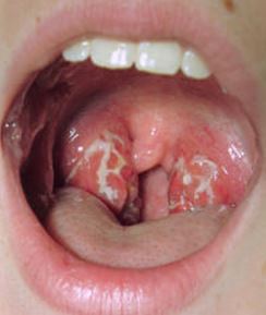 Holes in Tonsils Picture