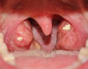 Holes in Tonsils with white Stuff or Chunk
