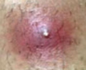 Infected Ingrown Hair Boil image