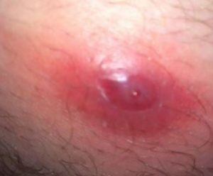 Infected Ingrown Hair Bump