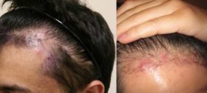 Ingrown Hair on Head Scalp Image