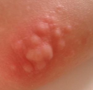 Itchy Bumps on Elbows