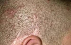 Itchy Bumps on Scalp Pictures
