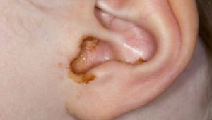 Itchy Ear Canal from Excessive Wax Secretion