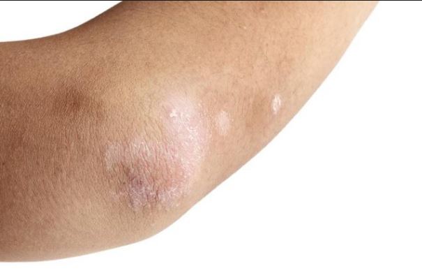 Itchy Elbows, Causes, Bumps, Rash, No Rash Non Itchy, Symptoms, Treat