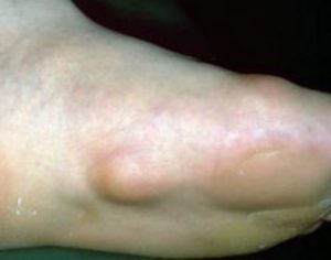 Foot sore on bottom for weeks