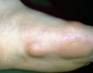 Painful Bumps on Bottom of Foot