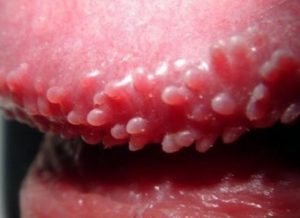 pearly penile papules reason