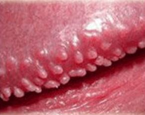 Pearly Penile Papules Picture