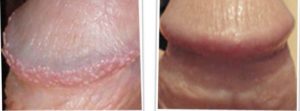 Pearly Penile Papules before and after treatment picture