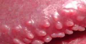 Pearly Penile Papules on Head Image