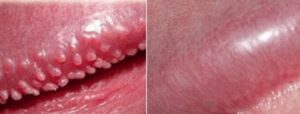 Pearly Penile Papules removal, treatment or cure
