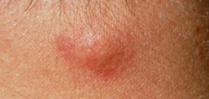 Red Bump formed underneath the Breast Skin - Picture