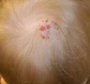 Red Bumps on Scalp Images