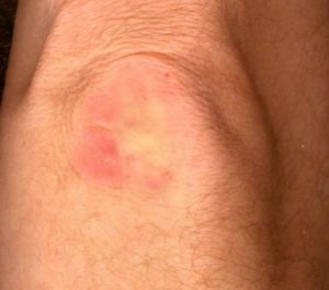 Red Itchy Elbow Skin Causes