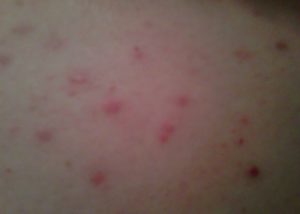Red Spots on side of Breast skin
