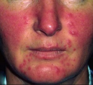 Redness around Nose, Mouth and Cheek-Picture