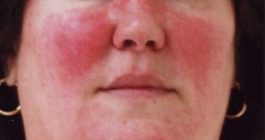 Redness around Nose and Mouth Image- Females