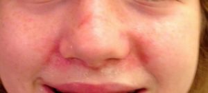 Redness around Nose and Mouth in Child caused by Perioral Dermatitis