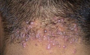 Small Bumps on Scalp and Neck