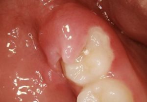 Swollen Gums around Wisdom Tooth - Infection Picture