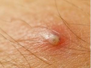 Symptoms of an Infected Ingrown Hair