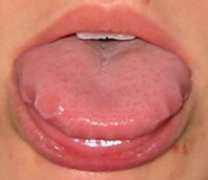 A Scalloped Tongue