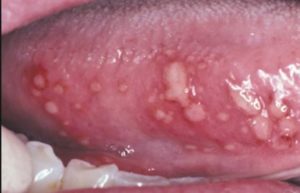 Inflamed Taste Buds under Tongue