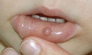 Mucous Cyst on Baby's Lip Picture