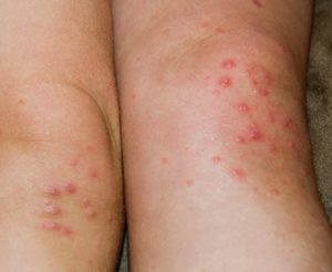 Red Bumps on Knees Pictures