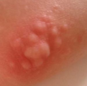 Red Itchy Bumps on Elbows