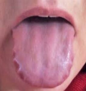 Scalloped Tongue Pictures