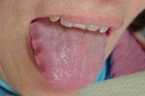 Scalloped Tongue Symptoms