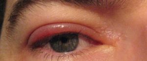 Staphylococcal Blepharitis on Eyelid