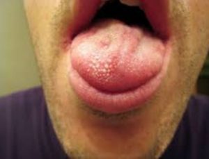 Swollen Taste Buds on Tip of Tongue