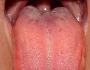 Swollen Taste Buds on back of Tongue