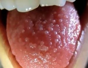Swollen Taste buds all over Tongue pictures