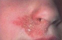 Dry Flaky Skin around Nose