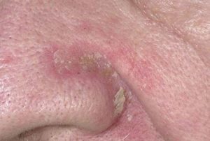 Dry Skin aound Nose Crease